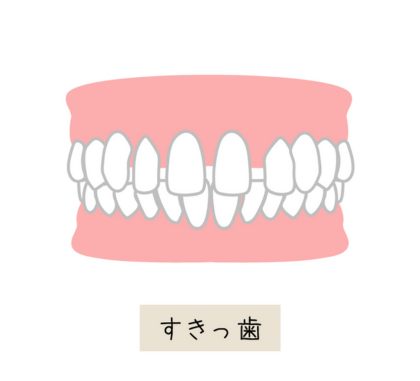 すきっ歯（空隙歯列）