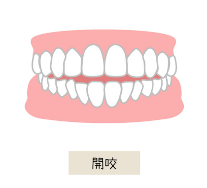 歯が閉じない（開咬）