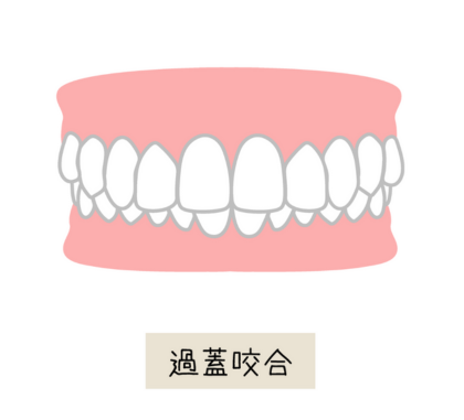 歯が閉じない（開咬）