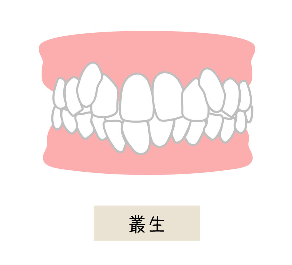 叢生　(そうせい・乱ぐい歯)